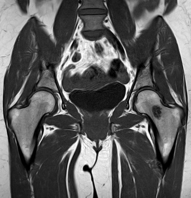 Effekte der Femur-Morphologie auf Muskelkräfte im Squat: 90% des 1RM